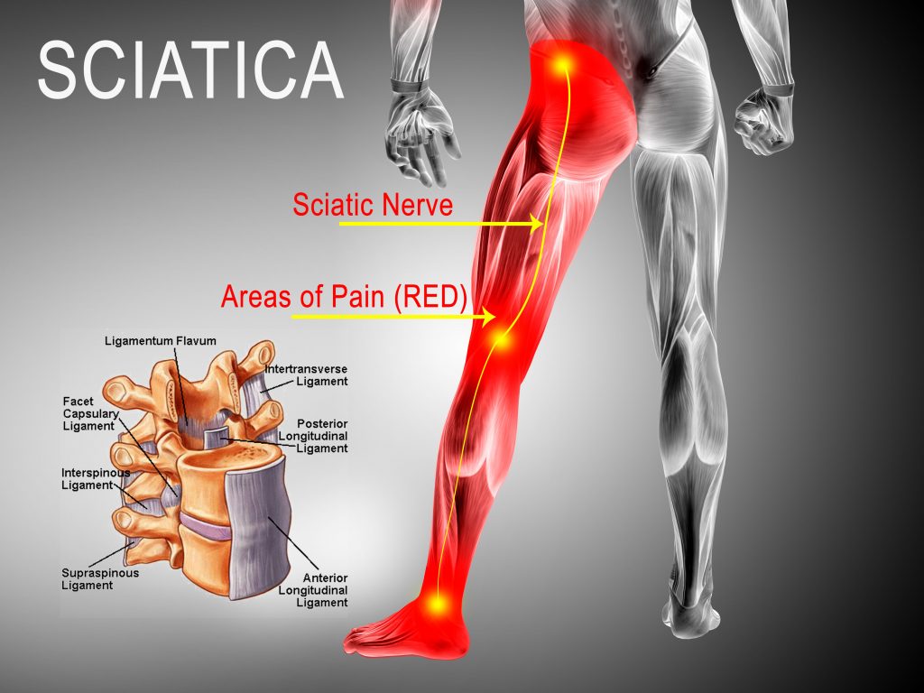 Chronic Sciatic Nerve Pain Treatment